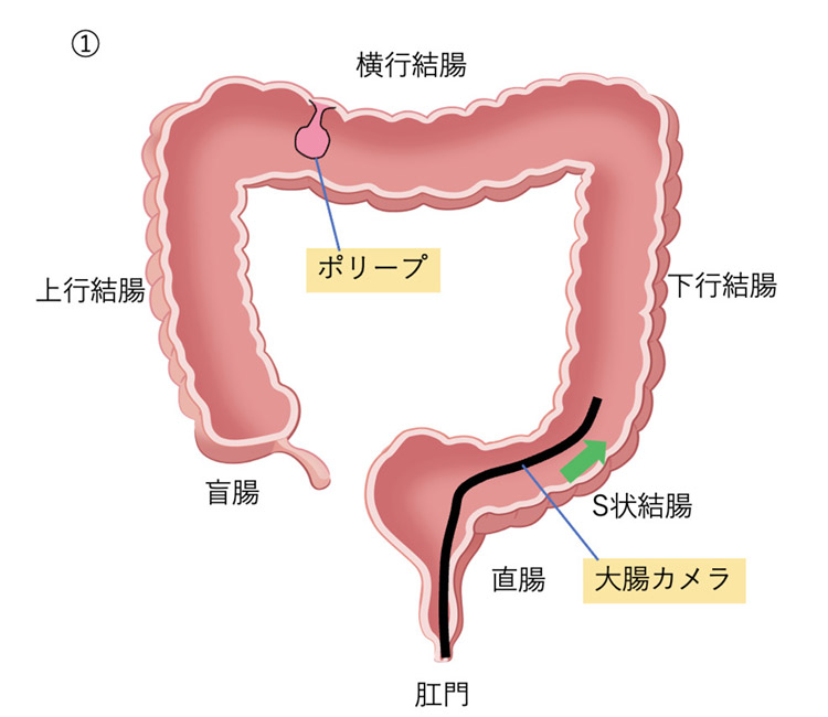 肛門から大腸内視鏡を挿入イメージイラスト
