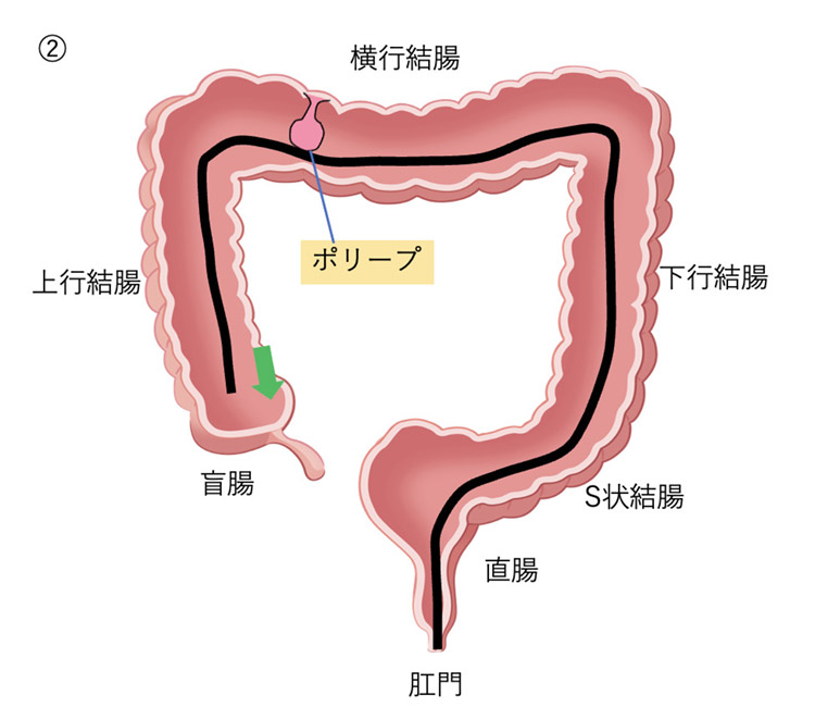 まず盲腸まで内視鏡を挿入イメージイラスト