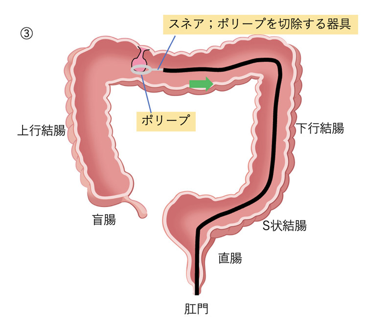 発見したポリープを切除イメージイラスト