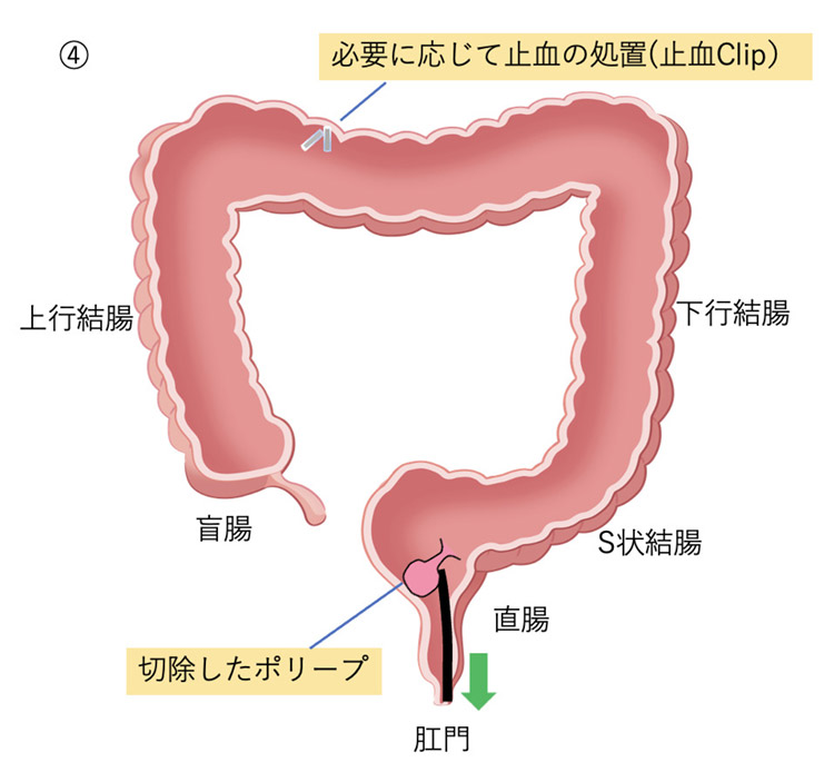 切除したポリープを回収して肛門から取り出すイメージイラスト