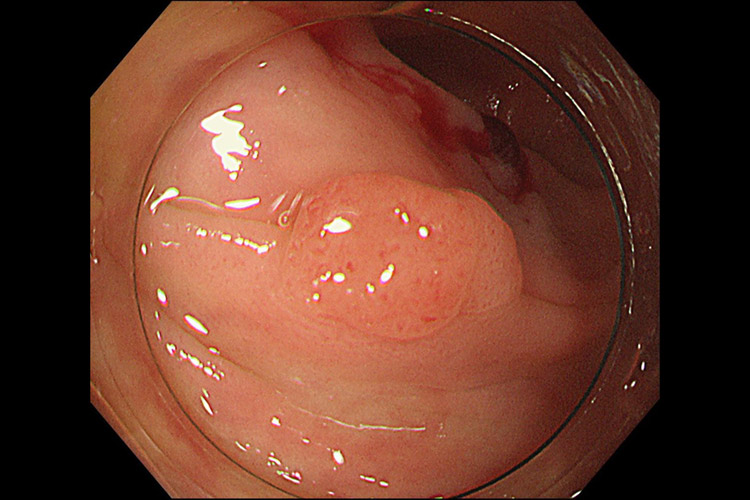①切除可能なポリープを発見(約7mmの平坦横長のポリープ)。