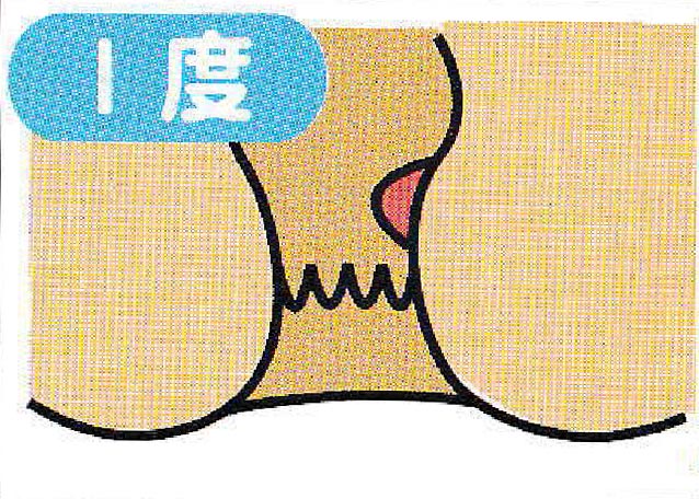 内痔核 Ⅰ度のイメージイラスト