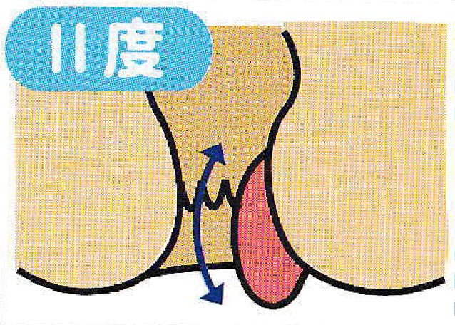 内痔核 Ⅱ度のイメージイラスト