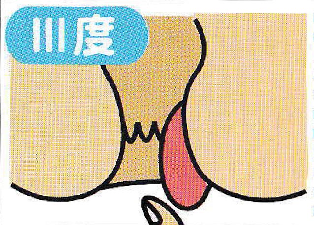 内痔核 Ⅲ度のイメージイラスト