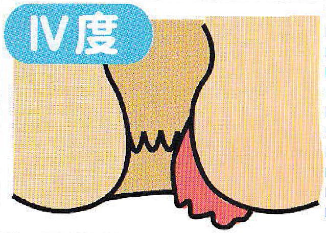 内痔核 Ⅳ度のイメージイラスト