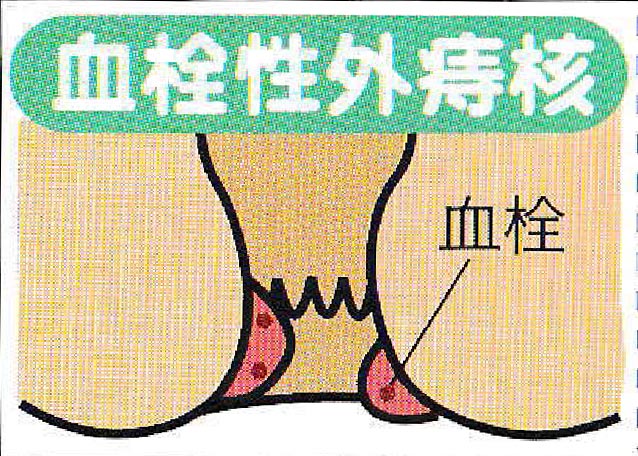 血栓性外痔核のイメージイラスト