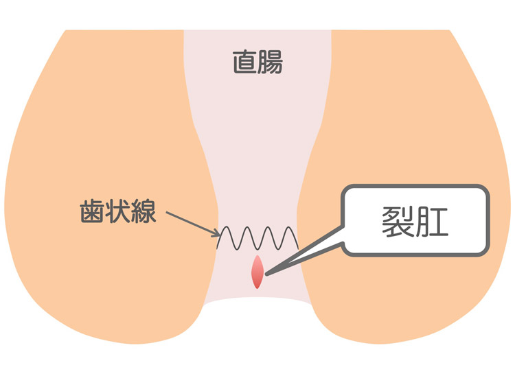 裂肛のイメージイラスト