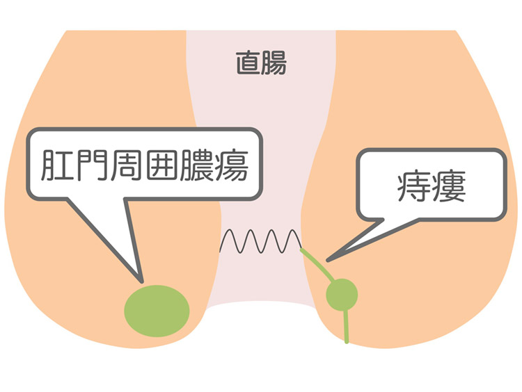 痔瘻 肛門周囲膿瘍のイメージイラスト
