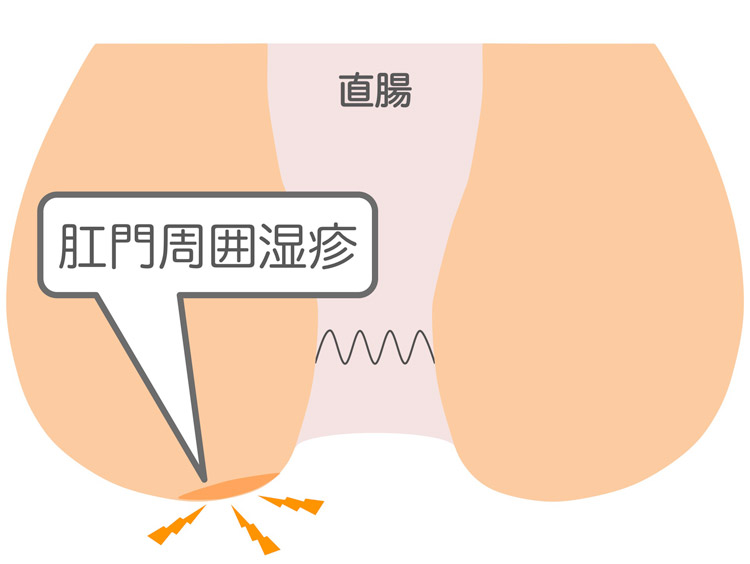 肛門周囲湿疹のイメージイラスト